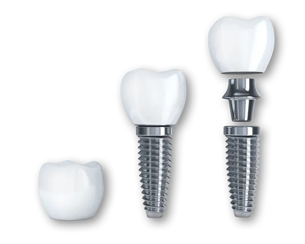 Dental implant parts: a porcelain crown, an abutment and a titanium post